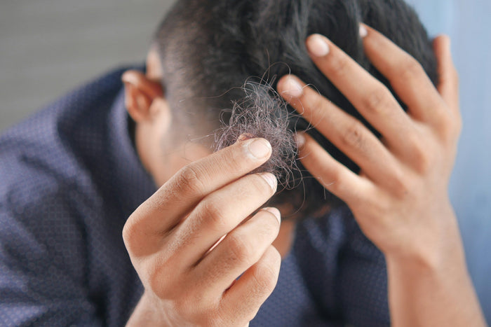 Man holding fallen hair, showing hair loss.
